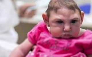 Трисомия по 18 хромосоме синдром эдвардса