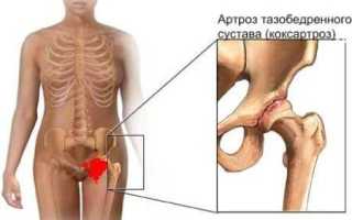 Если болит тазобедренный сустав симптомы