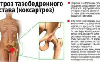 Коксартроз причины