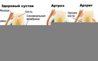 Артрит артроз лечение народными средствами