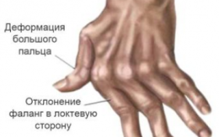Лечение при ревматоидном артрите суставов