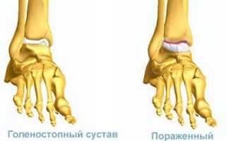 Воспаление сустава голеностопа