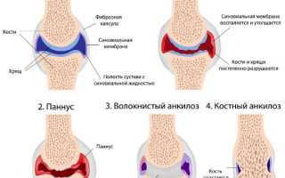 Инвалидность при артрите