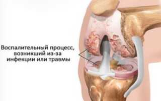 Болит сзади коленки