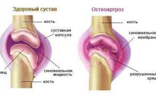 Остеоартроз суставов