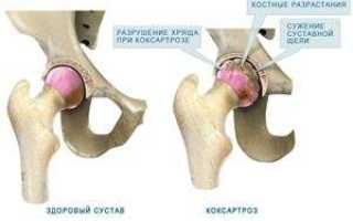 Коксартроз 2 стадии