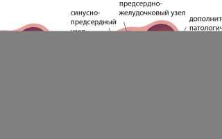Отличие феномена wpw от синдрома