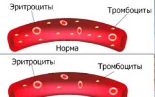 Тромбоцитопения у детей мкб 10 код