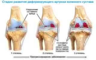 Профилактика болезней суставов