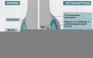 Остеоартроз степени