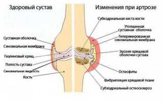 Как лечить колени суставы