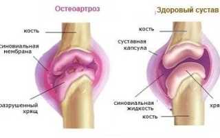 Признаки артроза плечевого сустава