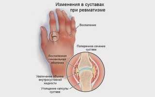 Полиартрит лечение