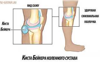 Киста в коленном суставе