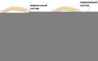 Лечение плечелопаточного периартрита