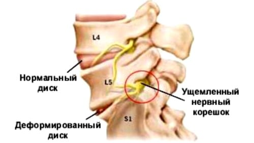 Шейный остеохондроз с корешковым синдромом