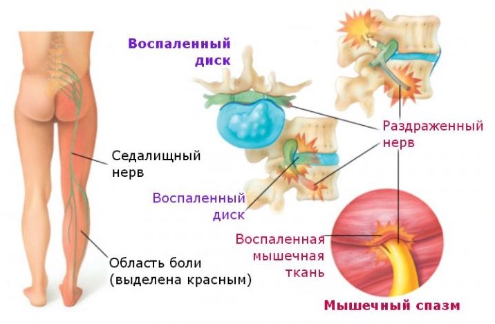 Ишиас