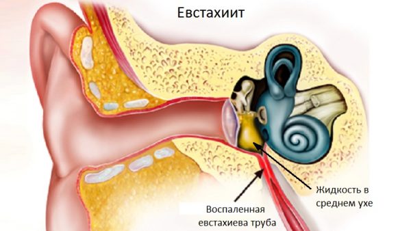 Как проявляется турбоотит Как проявляется турбоотит