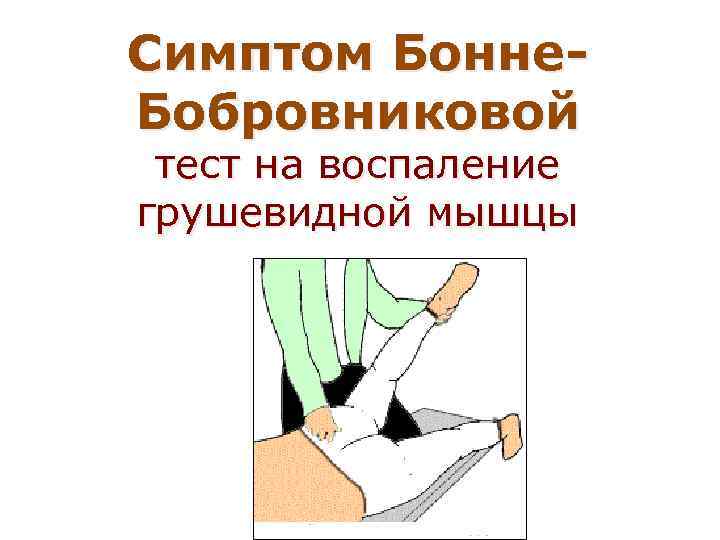 Положительный симптом грушевидной мышцы (симптом Бонне-Бобровниковой)