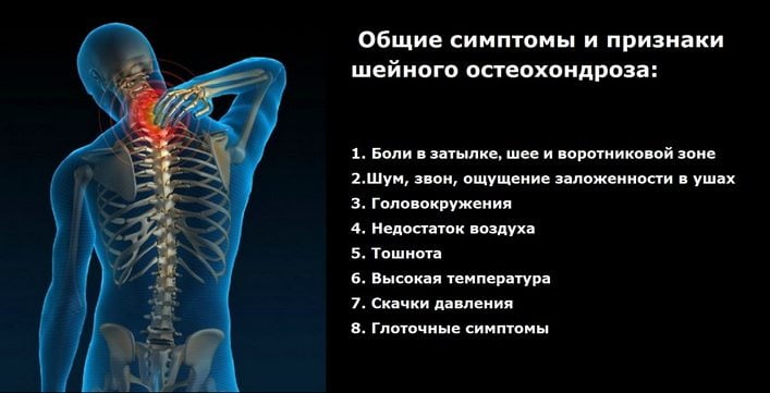 Шейный остеохондроз с корешковым синдромом