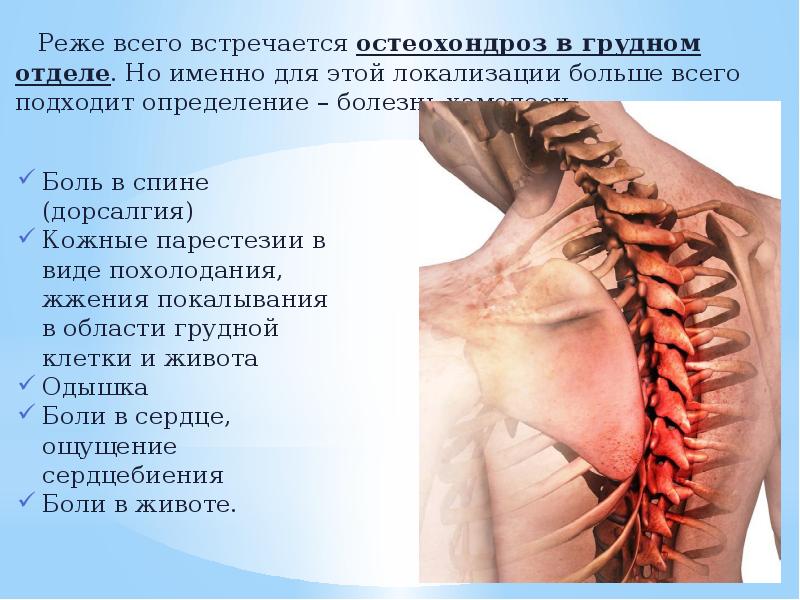 Шейный остеохондроз с корешковым синдромом