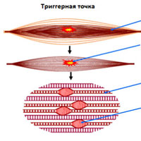 Миофасциальная боль Миофасциальная боль