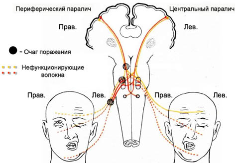 nevrit-liczevogo…a-paralich-bella parez Неврит лицевого нерва (паралич Белла)
