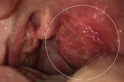 paratonzillyarnyj-absczess primer Паратонзиллярный абсцесс