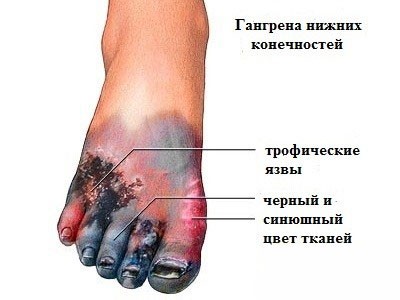 Признаки сухой гангрены ног Признаки сухой гангрены ног