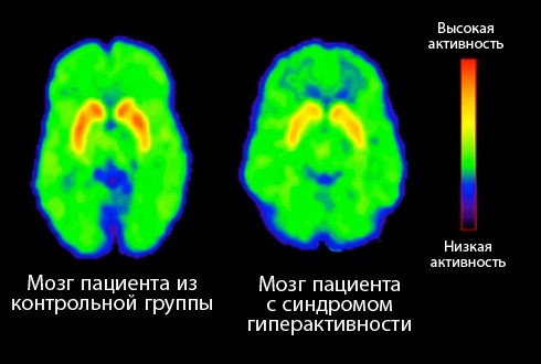 СДВГ у взрослых СДВГ у взрослых