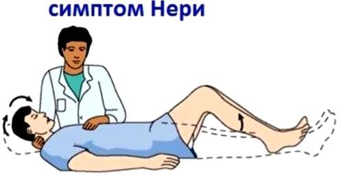Шейный остеохондроз с корешковым синдромом