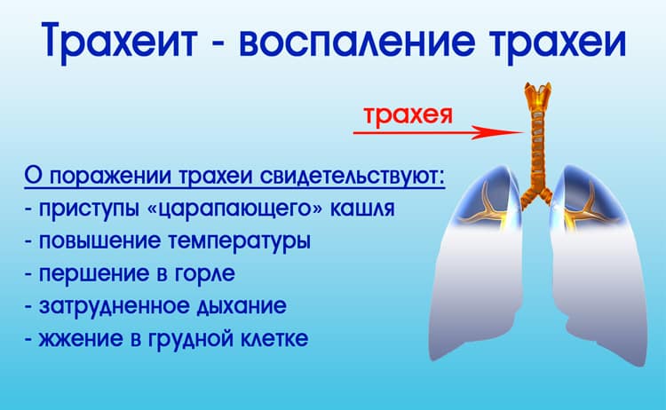 Воспаление трахеи – серьезное осложнение болезни Воспаление трахеи – серьезное осложнение болезни