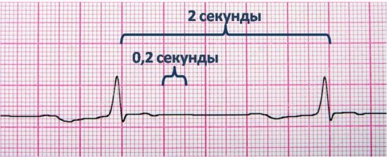 Патология на ЭКГ