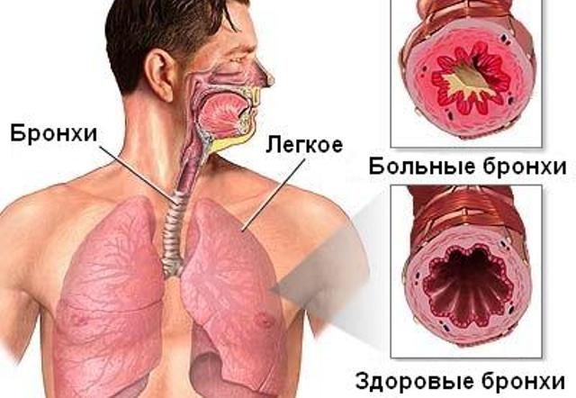 Здоровые бронхи и воспаленные при поражении астматическим бронхитом Здоровые бронхи и воспаленные при поражении астматическим бронхитом